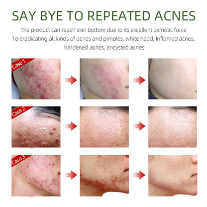 Herbal Acne Cream For Reducing Acne Marks